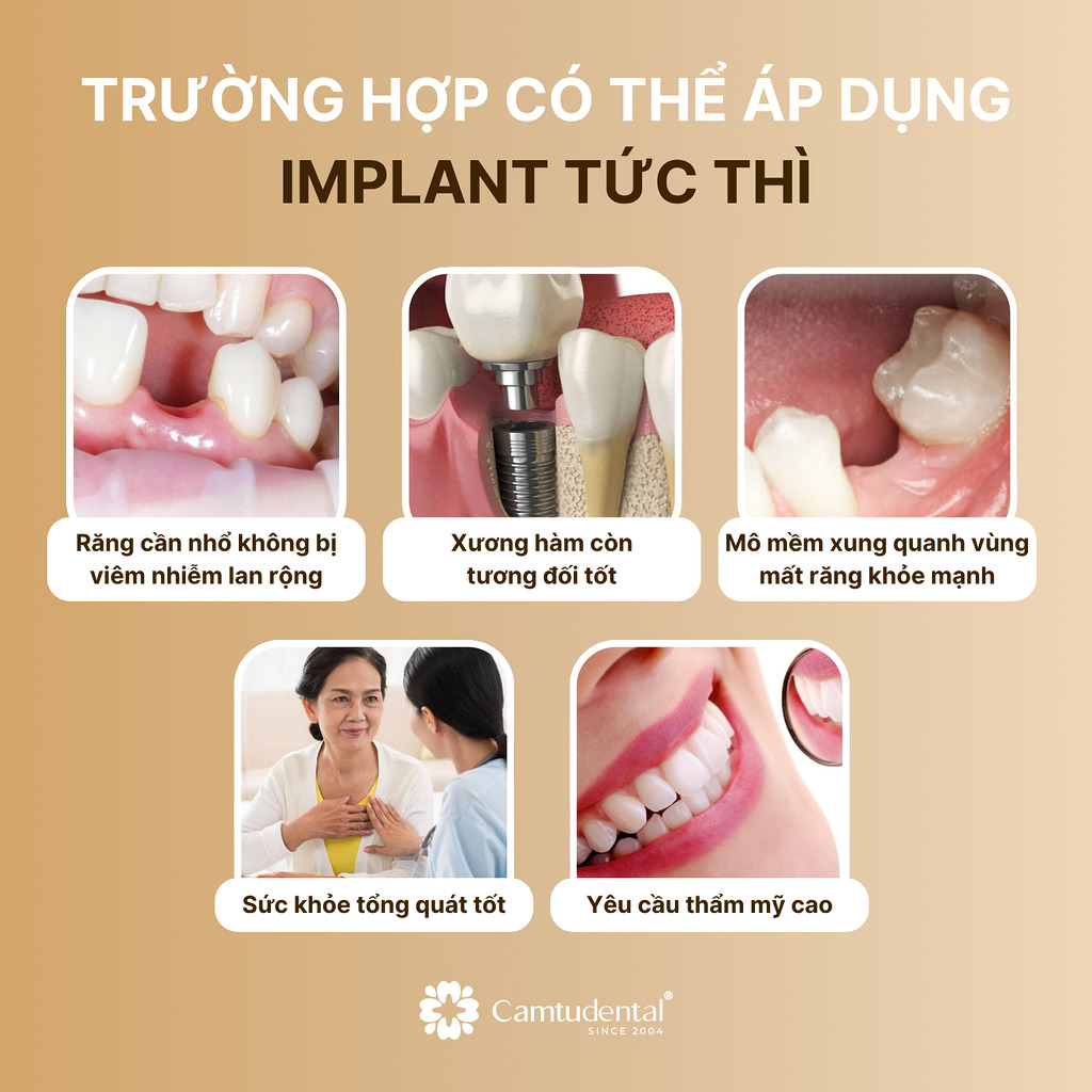 5 Trường Hợp Có Thể Áp Dụng Implant Tức Thì