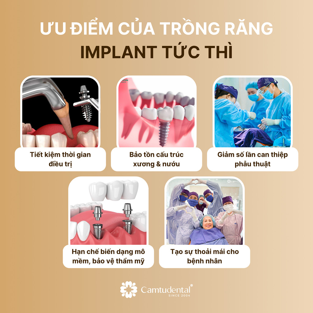 Ưu Điểm Của Trồng Răng Implant Tức Thì