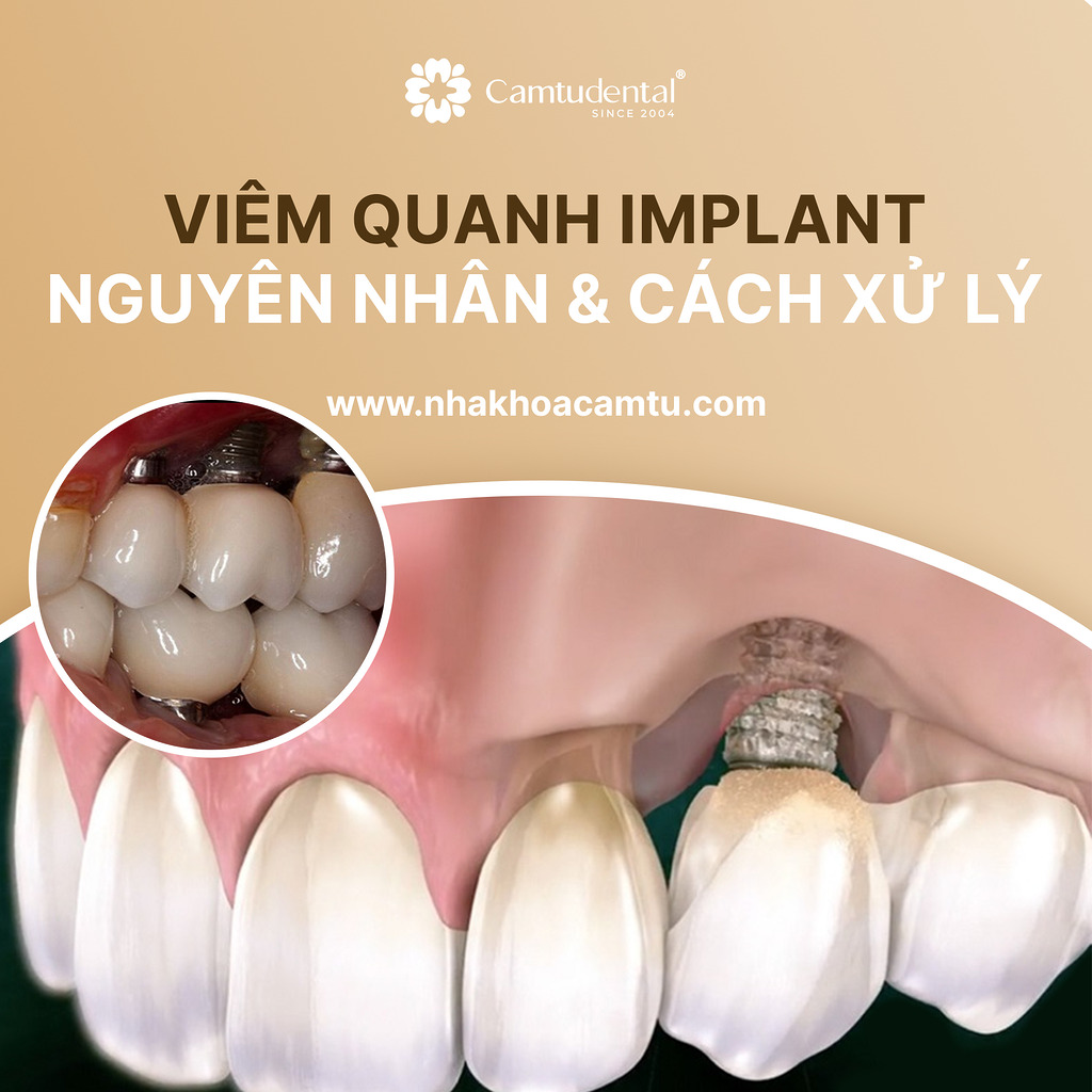 viêm quanh implant