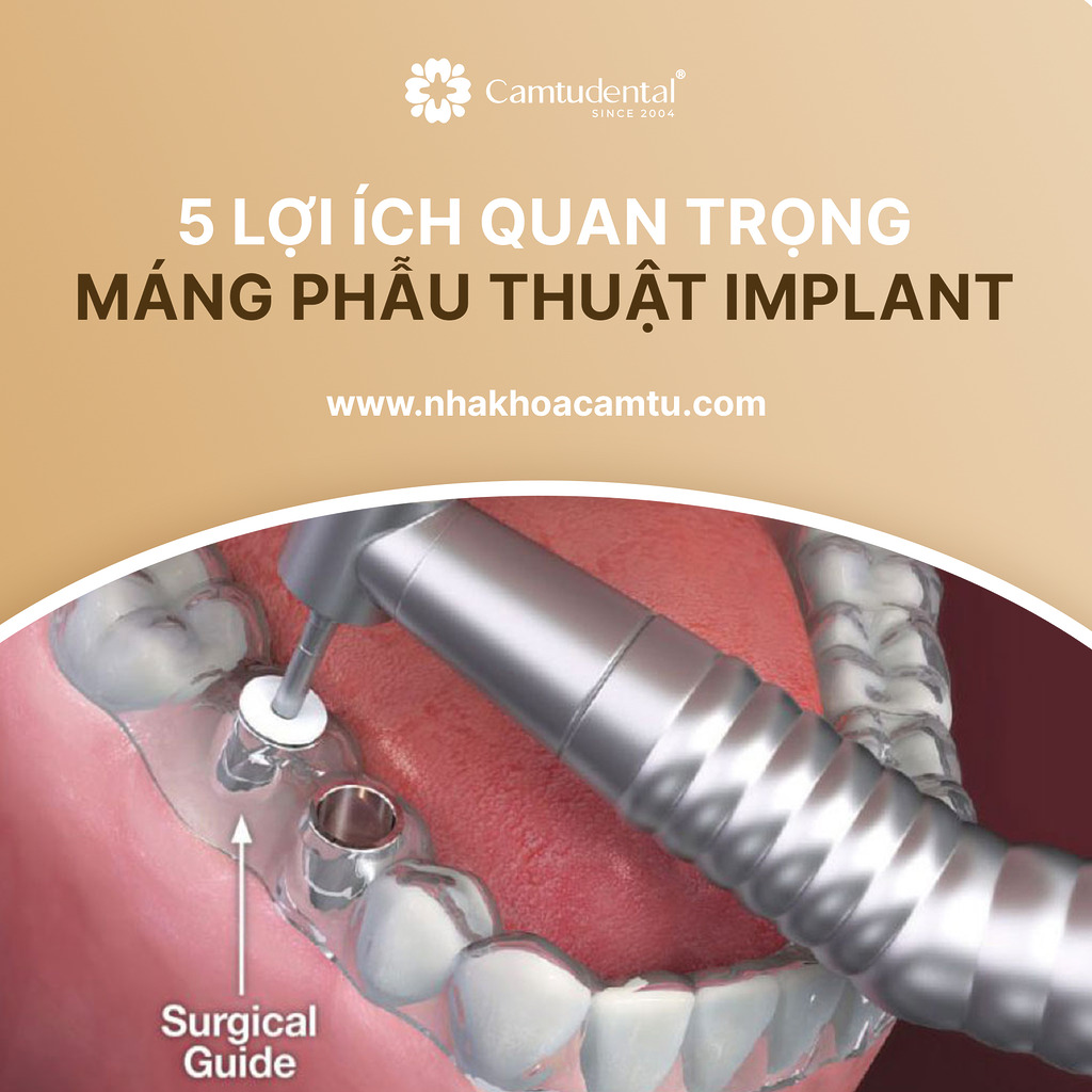 máng phẫu thuật implant