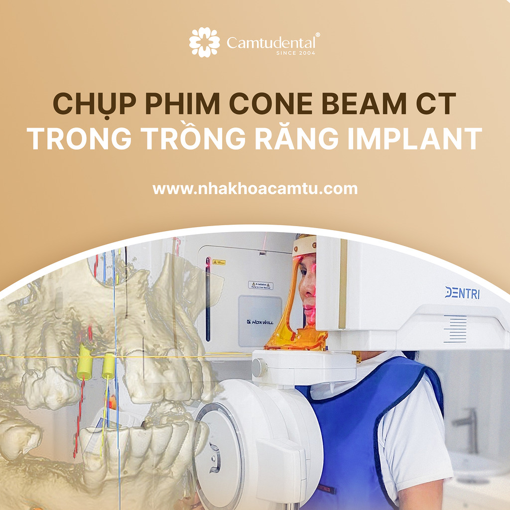 Chujp phim cone beam ct (cbct)
