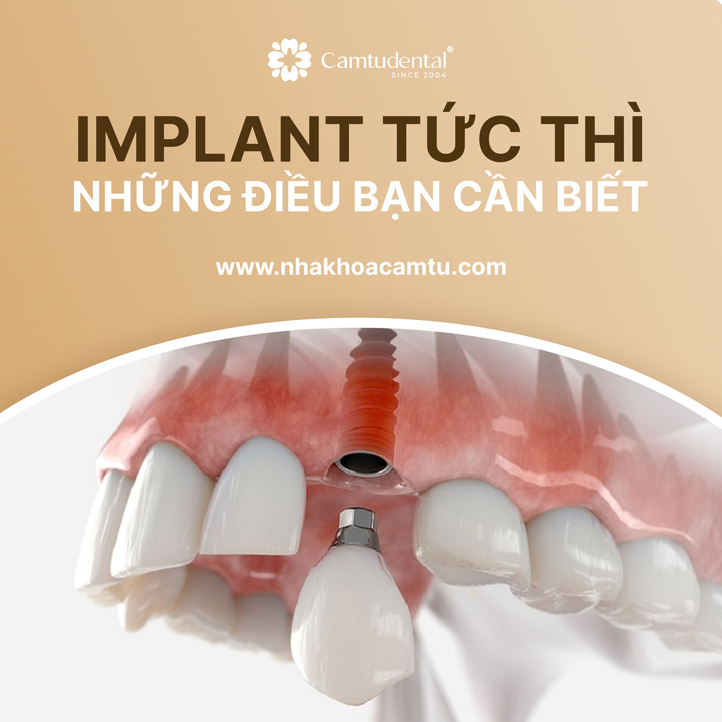 trồng răng implant tức thì