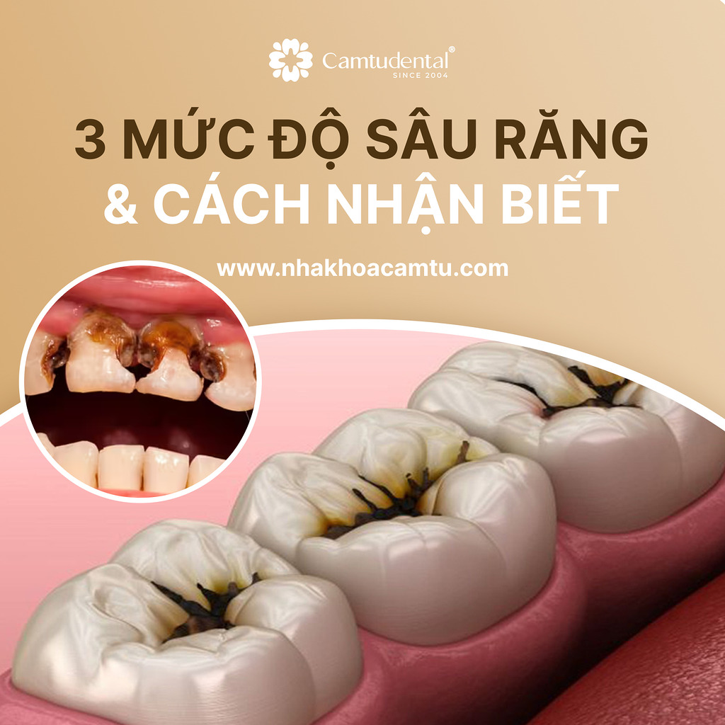 3 mức độ sâu răng và cách nhận biết