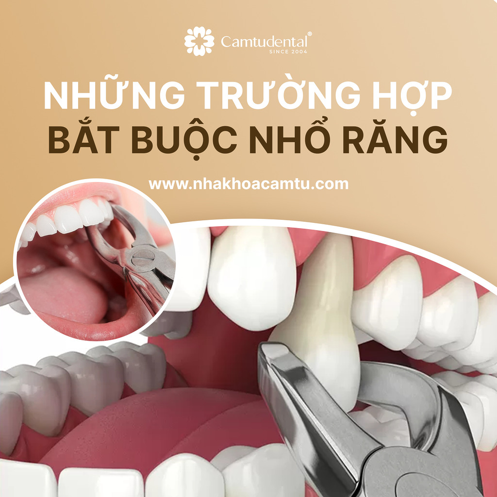 những trường hợp bắt buộc phải nhổ răng