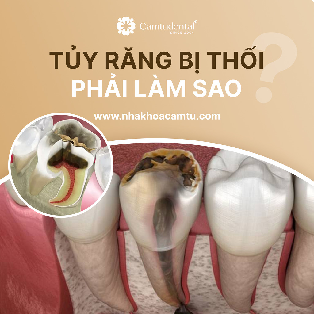 tủy răng bị thối phải làm sao