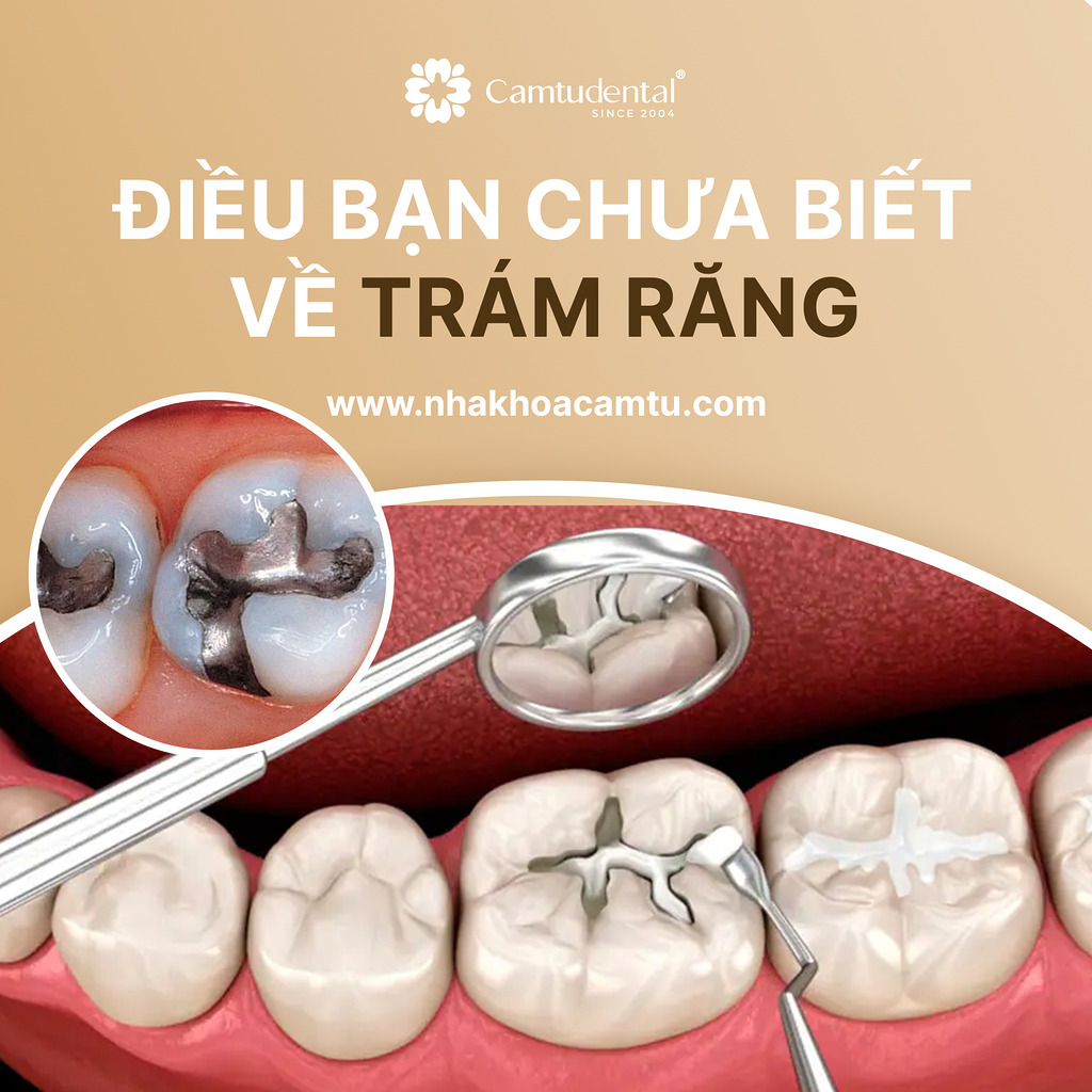trám răng