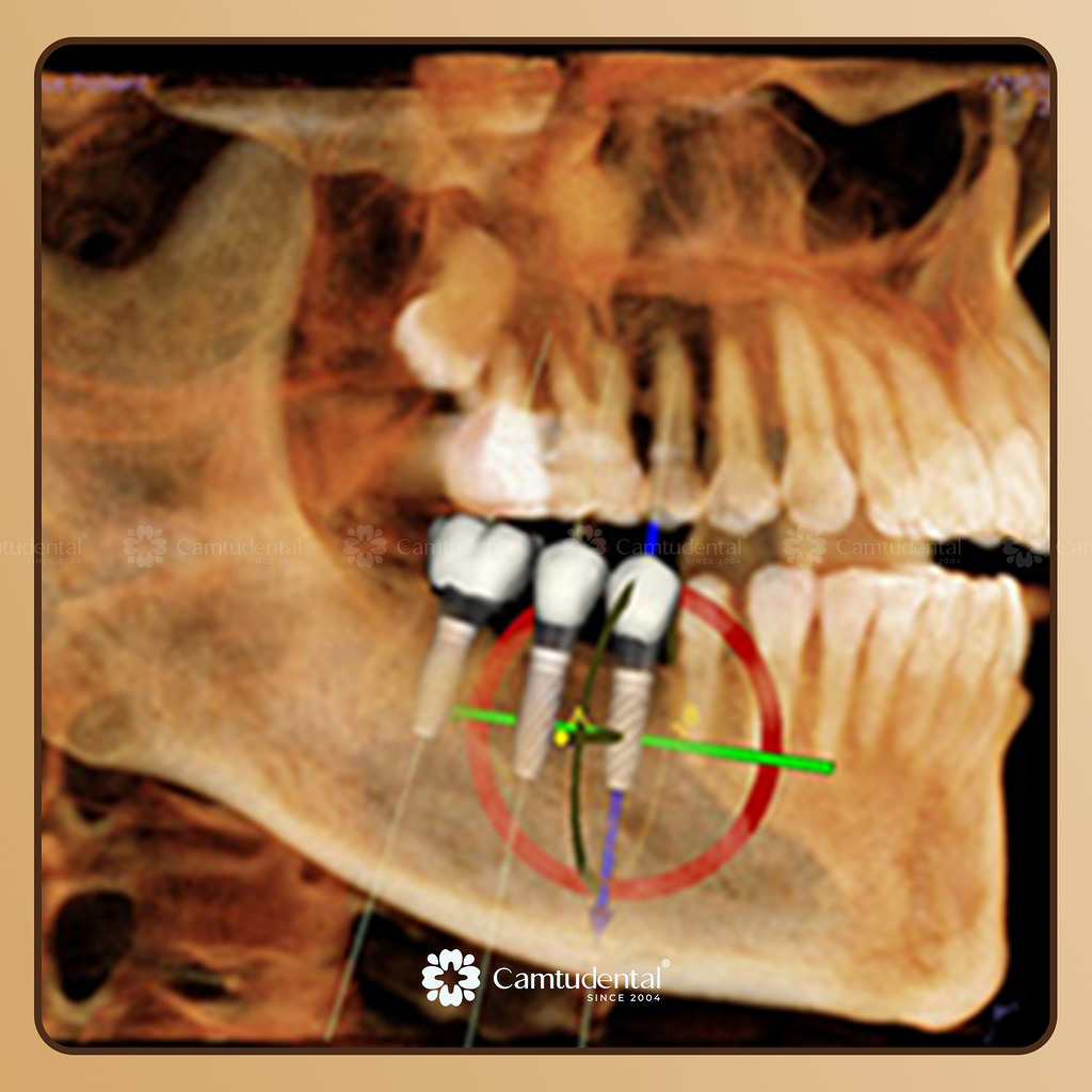Xác Định Vị Trí Cắm Trụ Implant Chính Xác