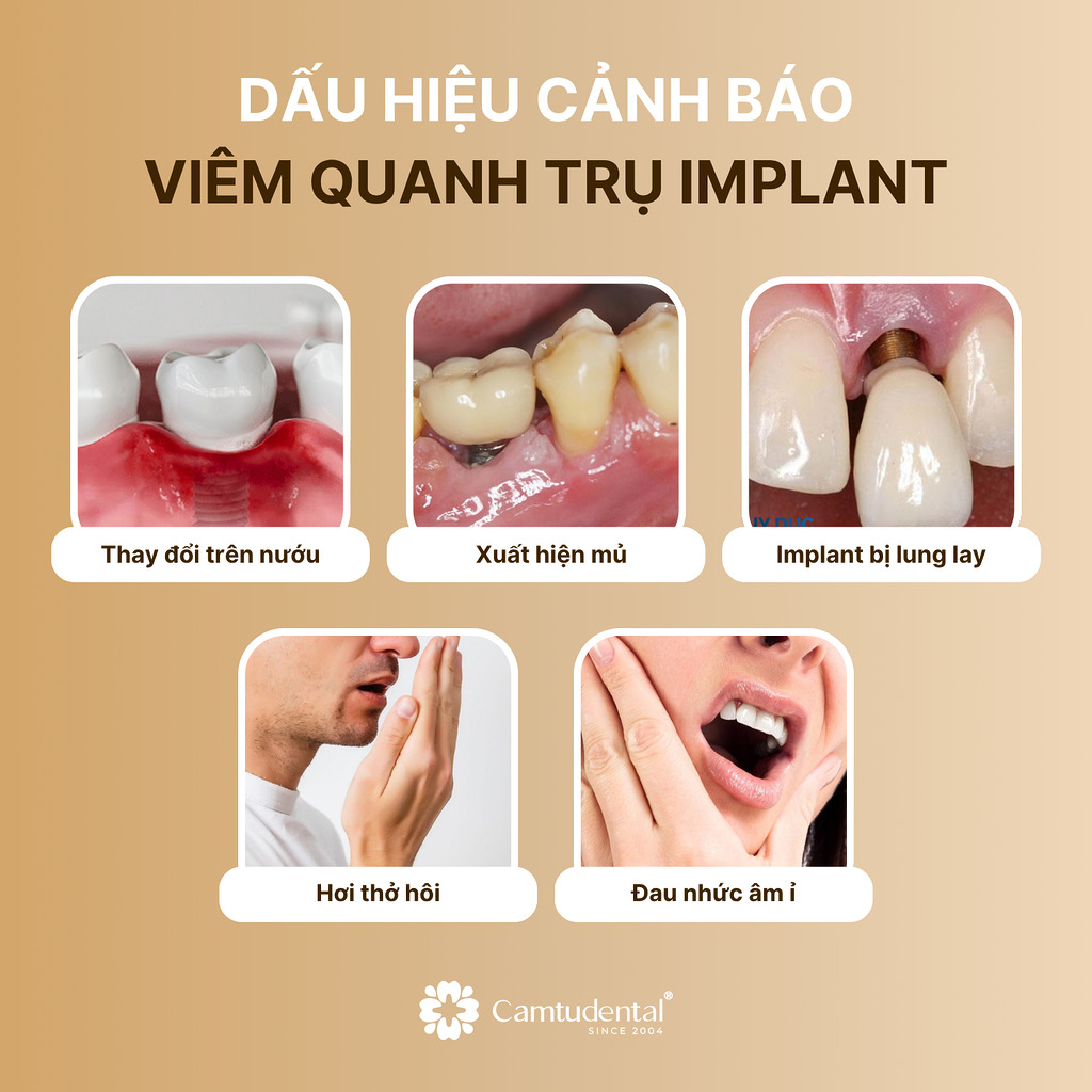 Dấu Hiệu Cảnh Báo Viêm Quanh Implant