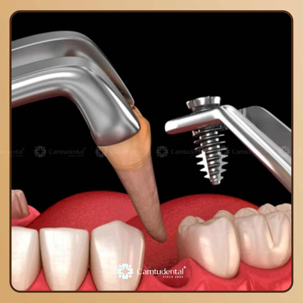 Cấy Ghép Implant Tức Thì