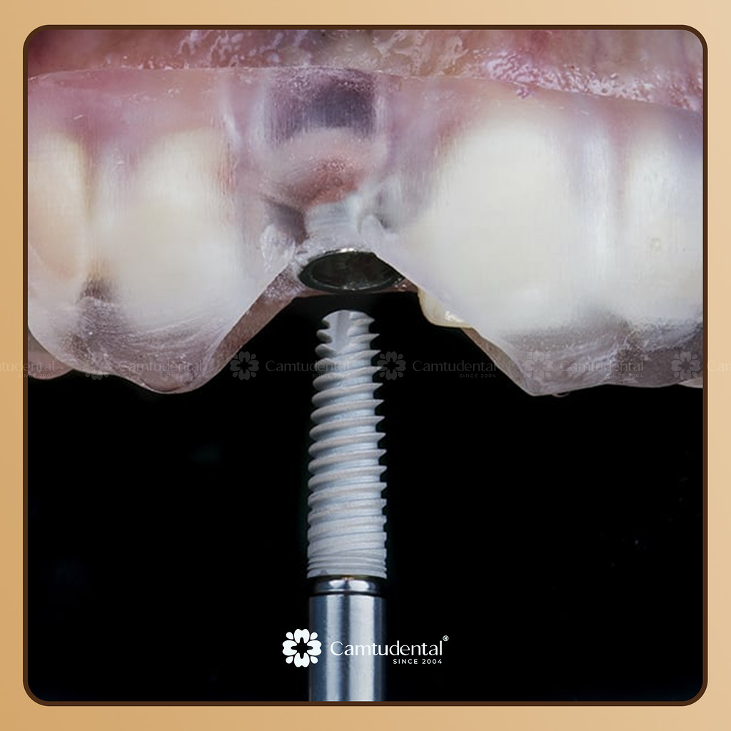 máng phẫu thuật implant