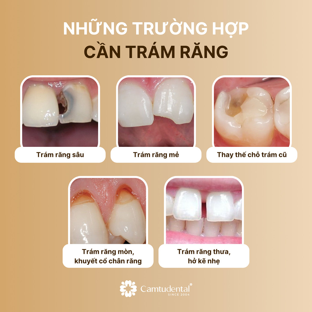những trường hợp cần trám răng
