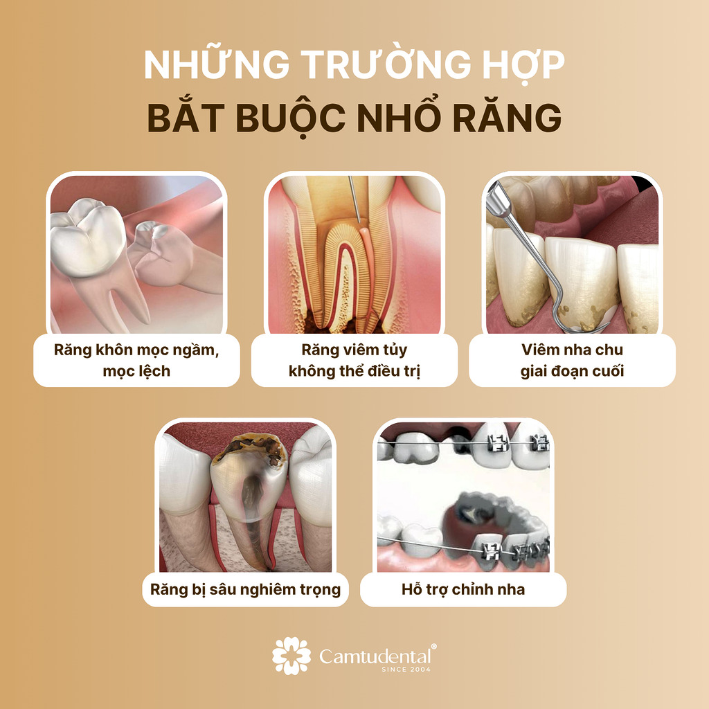 những trường hợp bắt buộc nhổ răng