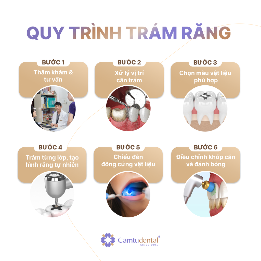 quy trình trám răng