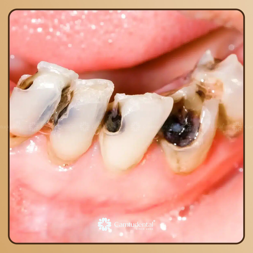 Sâu răng không được điều trị kịp thời