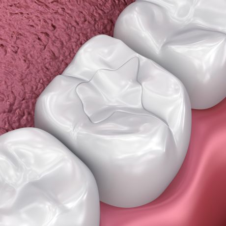 trám răng GIC (Glass Ionomer Cement)