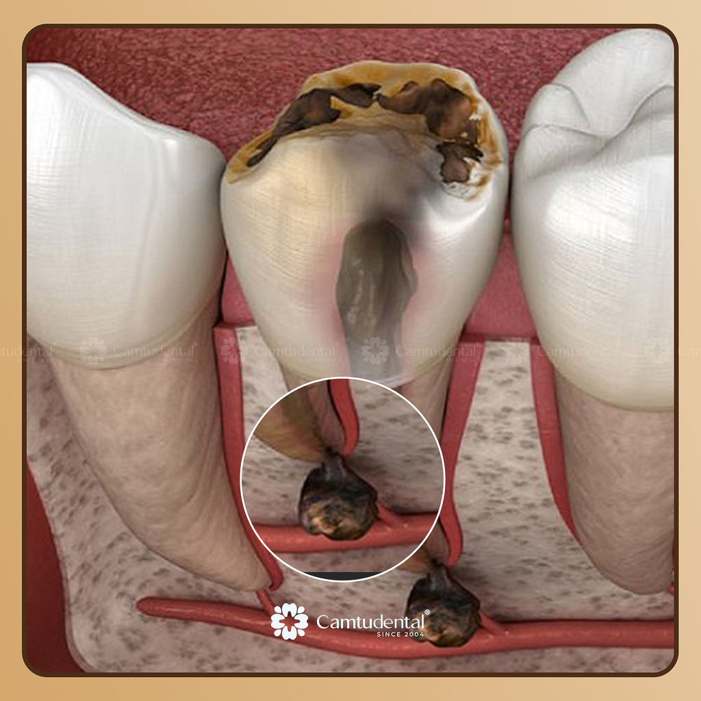 tủy răng bị thối