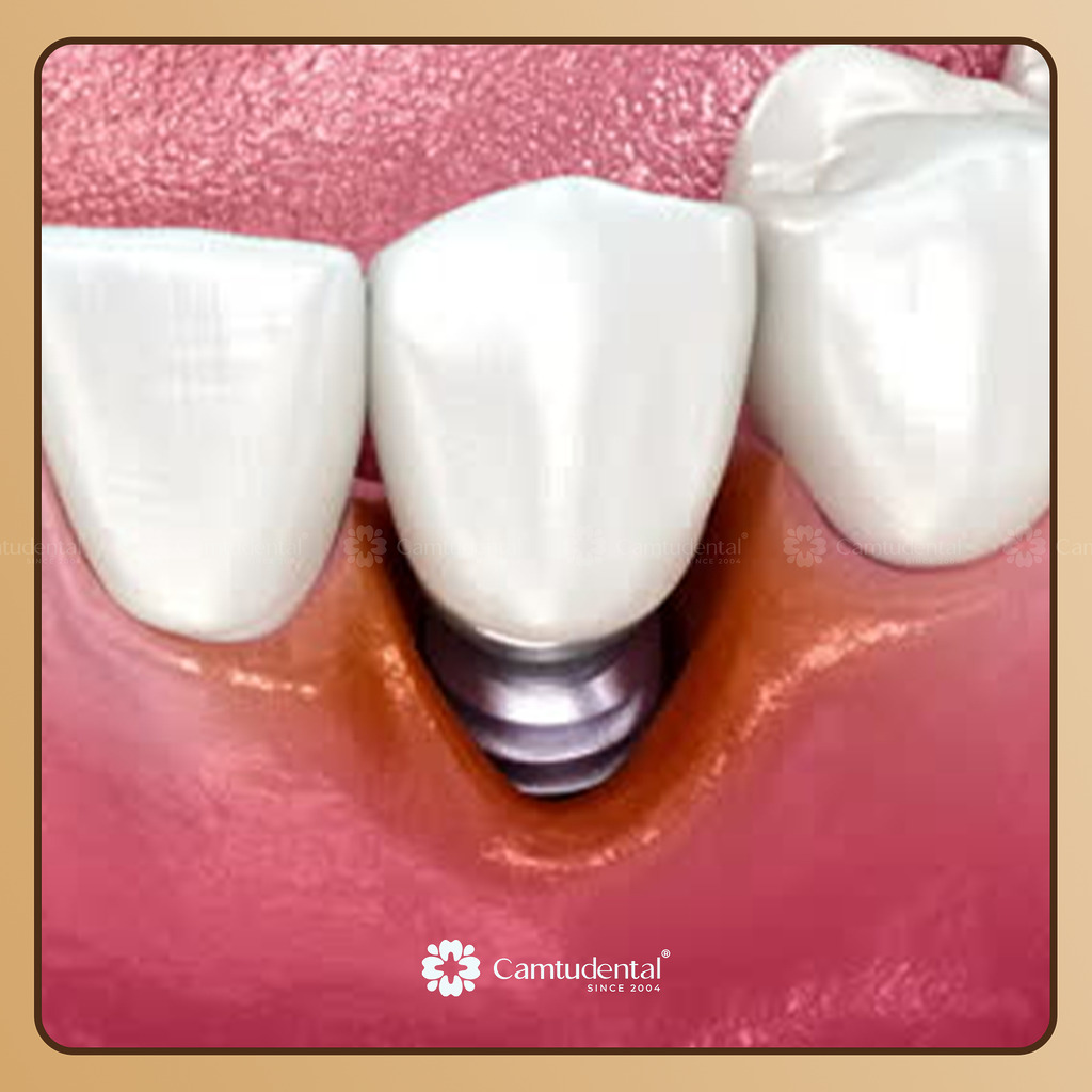 viêm quanh implant