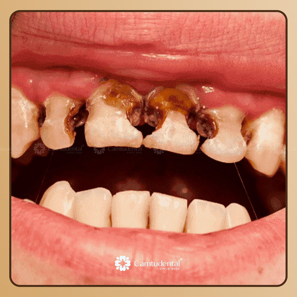 viêm tủy kéo dài không được điều trị