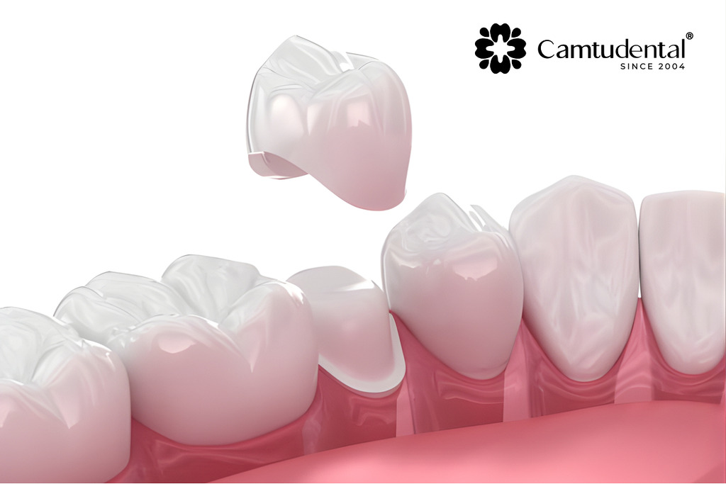 image 1 - RĂNG SAU ĐIỀU TRỊ TỦY: BAO LÂU THÌ NÊN PHỤC HÌNH? - Hệ thống Nha khoa Cẩm Tú