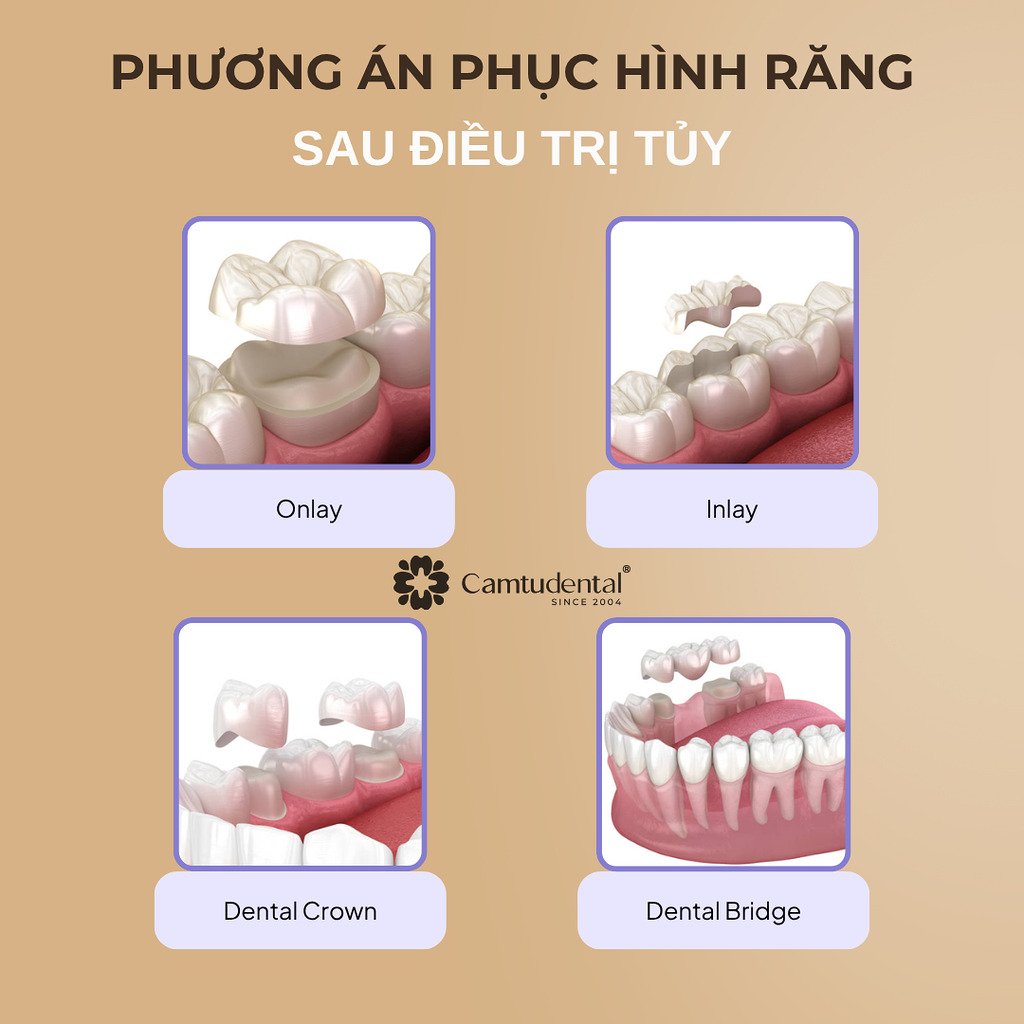 răng sau điều trị tủy