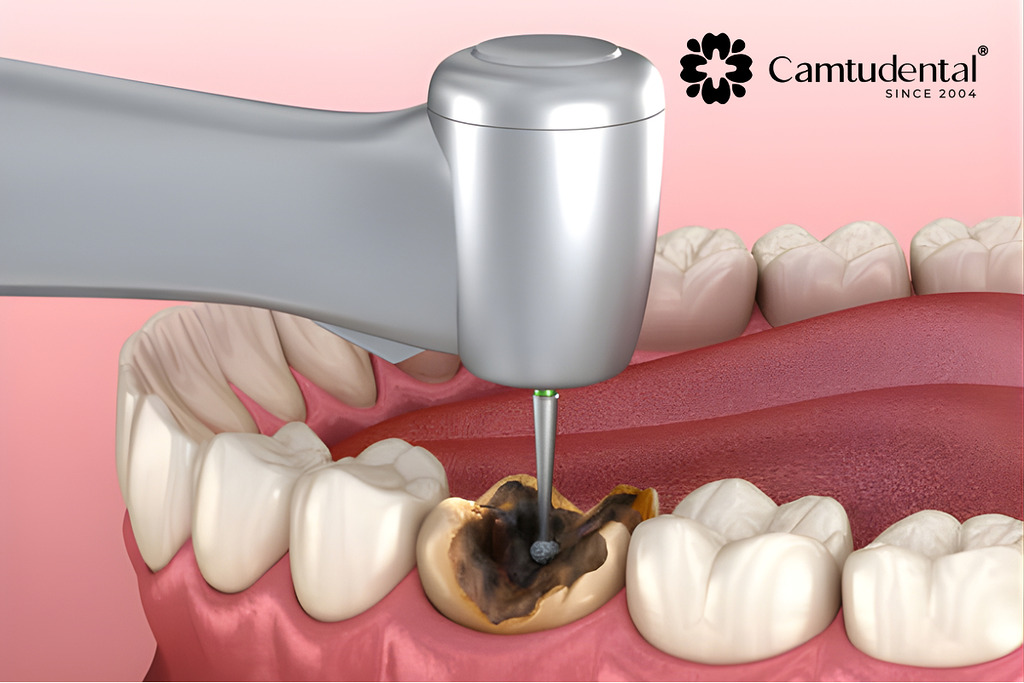 răng sau điều trị tủy