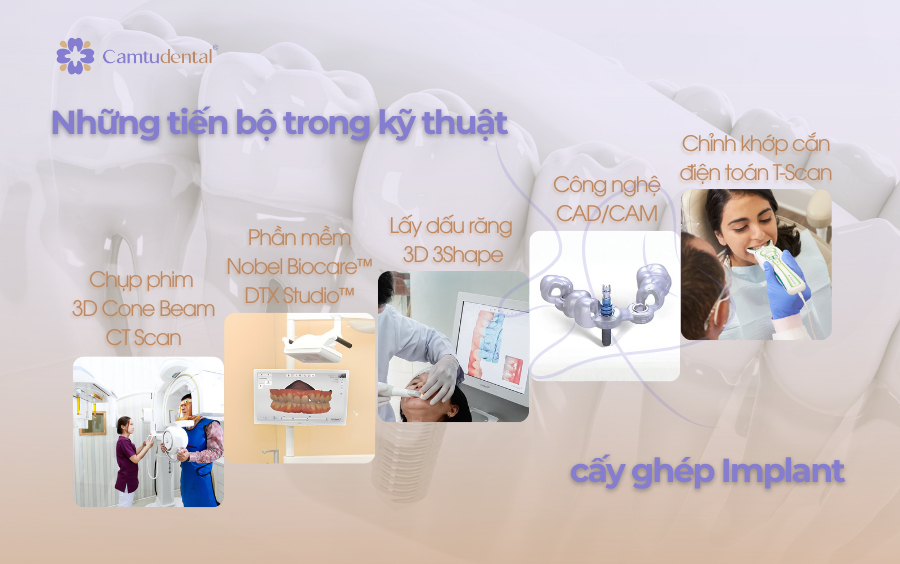 Nhung tien bo trong cay ghep Implant 1 - Sự tiến bộ trong quy trình cấy ghép Implant - Hệ thống Nha khoa Cẩm Tú