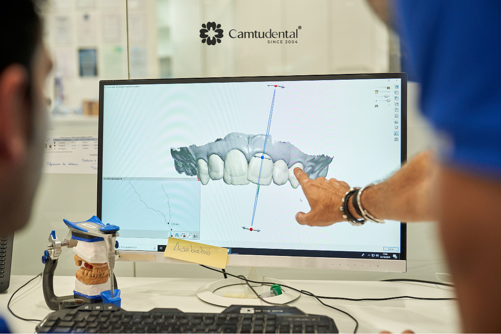 Niềng Răng Trong Suốt Cần Nhổ Răng Hay Không? 3 Uu nhuoc diem nho va khong nho khi nieng rang trong suot - Niềng Răng Trong Suốt Cần Nhổ Răng Hay Không? - Hệ thống Nha khoa Cẩm Tú