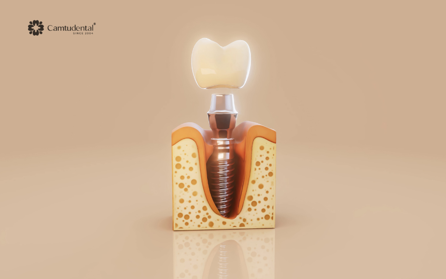 vì sao cấy ghép implant khác ngày trước