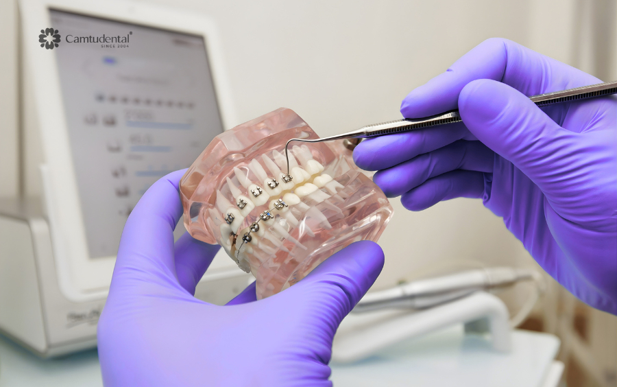 giá niềng răng của các loại phổ biến