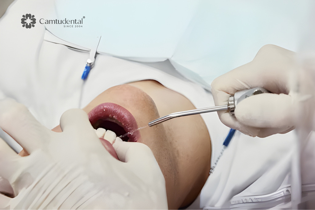 10 Dấu Hiệu Cảnh Báo Sớm Viêm Nướu Bạn Không Nên Bỏ Qua 2 khi nào viêm nướu cần đi khám