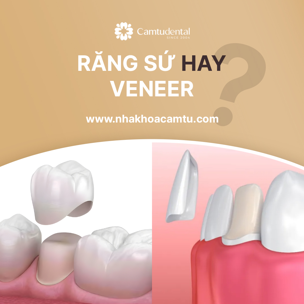 Nên bọc răng sứ hay dán veneer