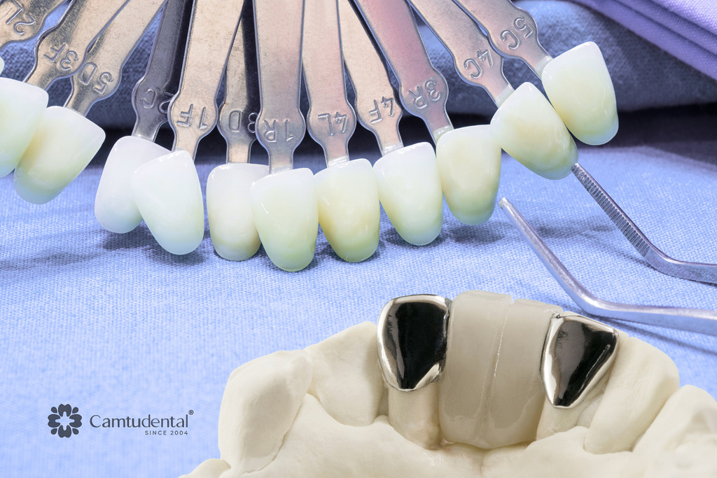 Nên bọc răng sứ hay dán sứ veneer 1 nên bọc răng sứ hay dán veneer