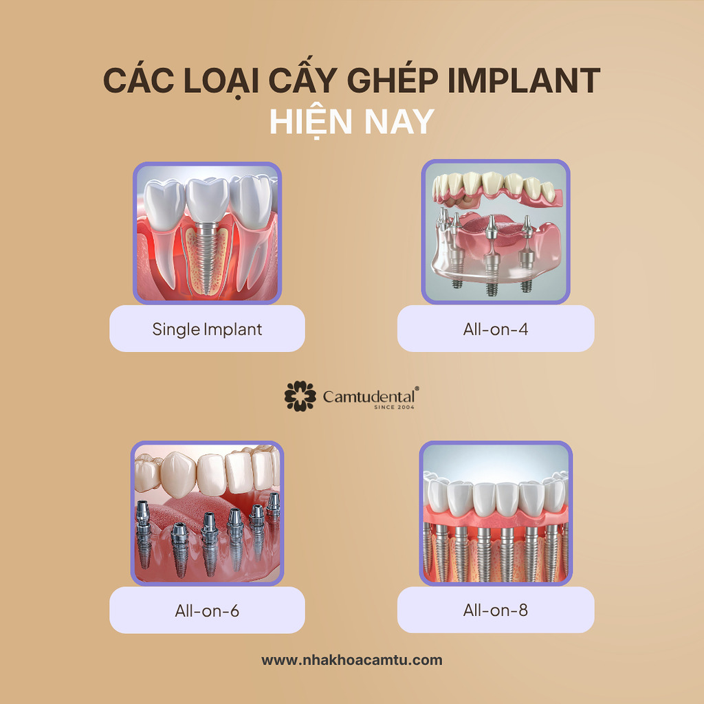 Trồng răng Implant 1 răng, nhiều răng, toàn hàm khác nhau thế nào về chi phí? 1 trồng răng implant