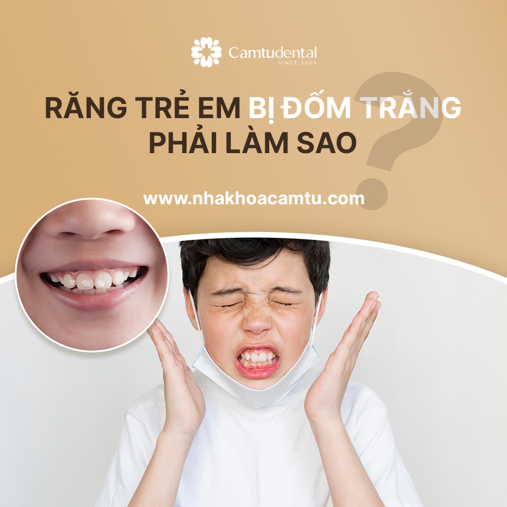 răng trẻ em bị đốm trắng