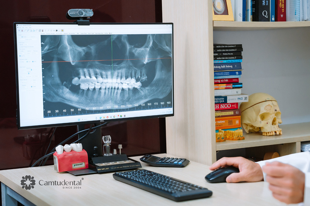 Trồng răng Implant 1 răng, nhiều răng, toàn hàm khác nhau thế nào về chi phí? 2 trồng răng implant