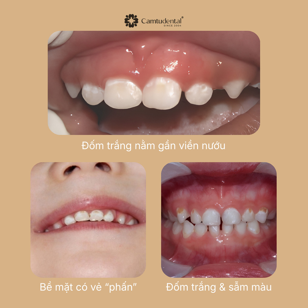 răng trẻ em bị đốm trắng