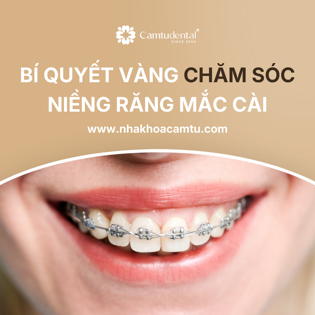 Bí quyết vàng chăm sóc niềng răng mắc cài