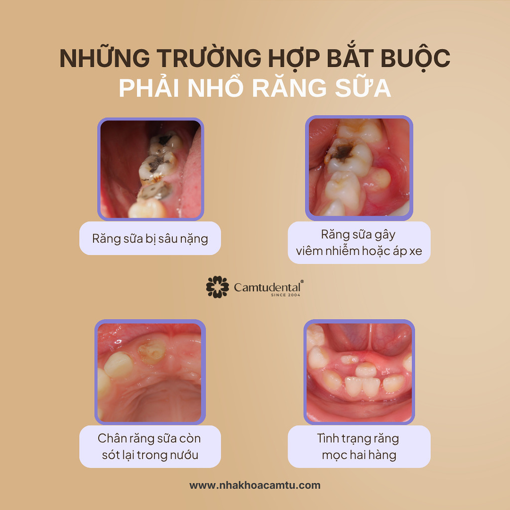 Nhổ răng sữa cho trẻ: Thời điểm và phương pháp tốt nhất 2 Anh Blog vuong 2 - Nhổ răng sữa cho trẻ: Thời điểm và phương pháp tốt nhất - Hệ thống Nha khoa Cẩm Tú