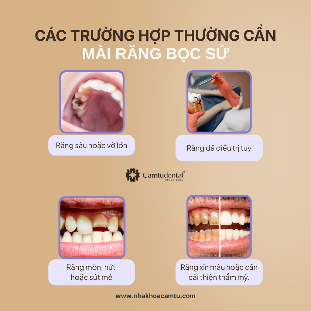 Mài Răng Bọc Sứ Có Ảnh Hưởng Gì Không? 4 Điều Bạn Cần Biết 2 Các trường hợp thường cần mài răng bọc sứ