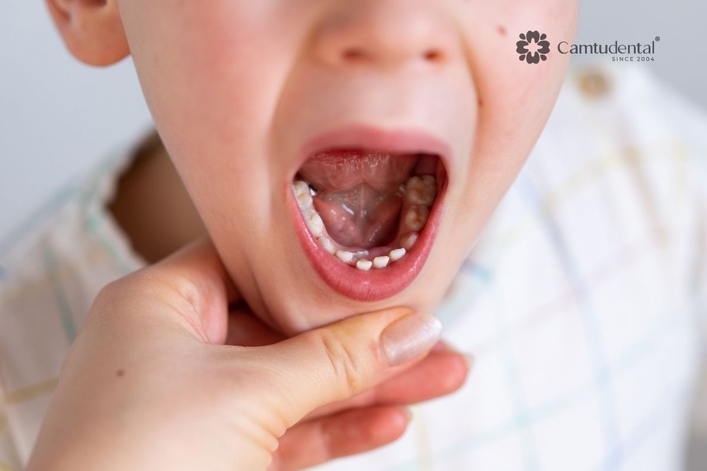 Kiểm tra răng sữa tại nha khoa trẻ em để phát hiện sớm tổn thương
