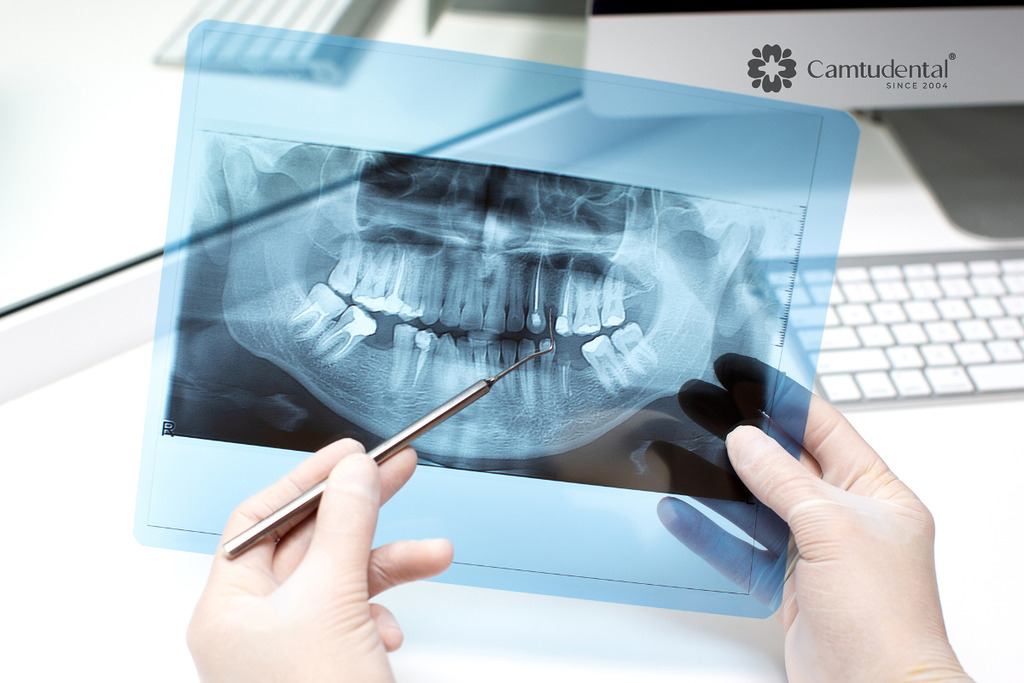 Tư vấn Trồng Răng Implant